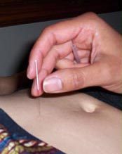 a hand reaching for an acupuncture needle inserted just above the navel